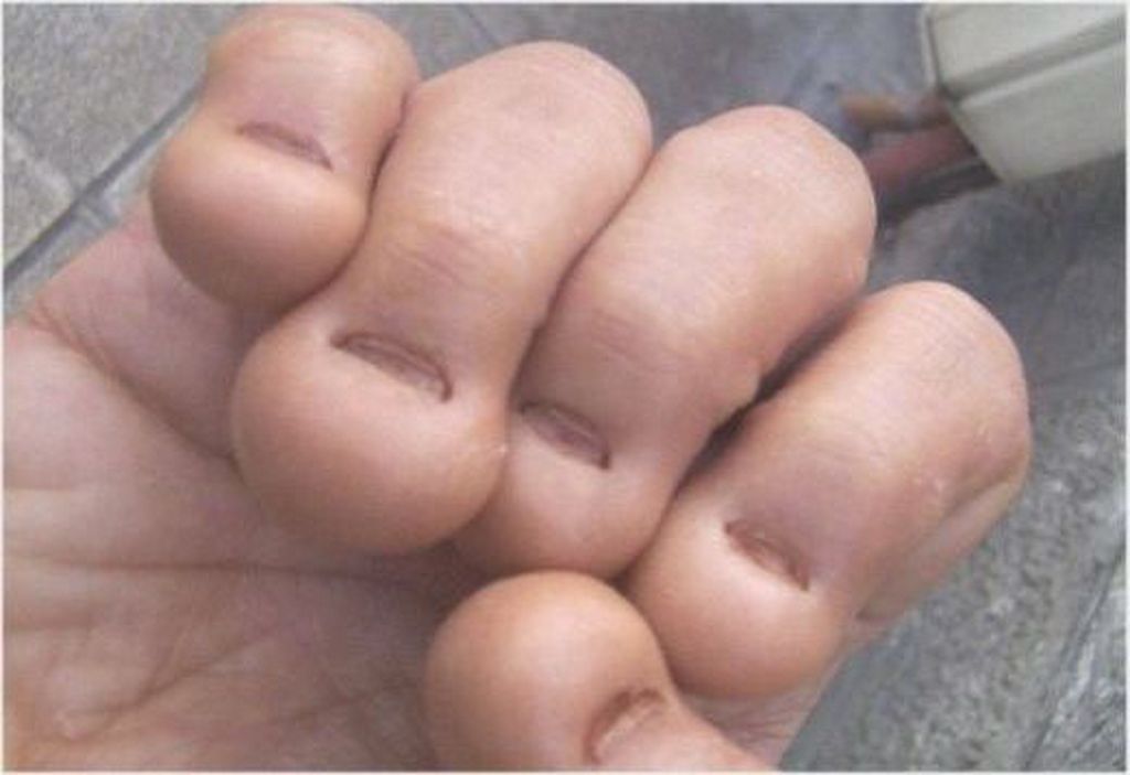 nailbiting.jpg